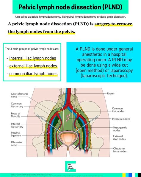 Pelvic Lymph Node Dissection Diagram