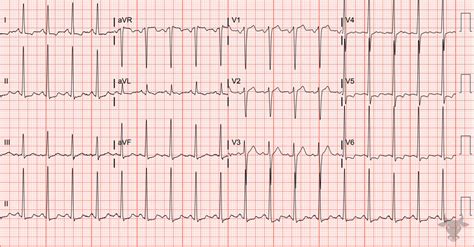 Left Ventricular Hypertrophy | ECG Stampede