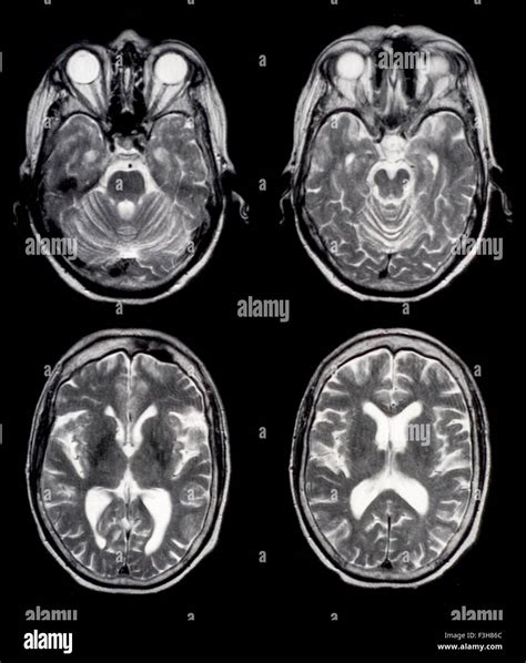 Brain Mri Images