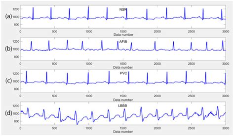 Lightweight Ensemble Network for Detecting Heart Disease Using ECG Signals
