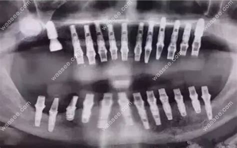 全口无牙需要种几颗种植牙是因人而异,满口可种8到16颗 - 口腔资讯 - 牙齿矫正网