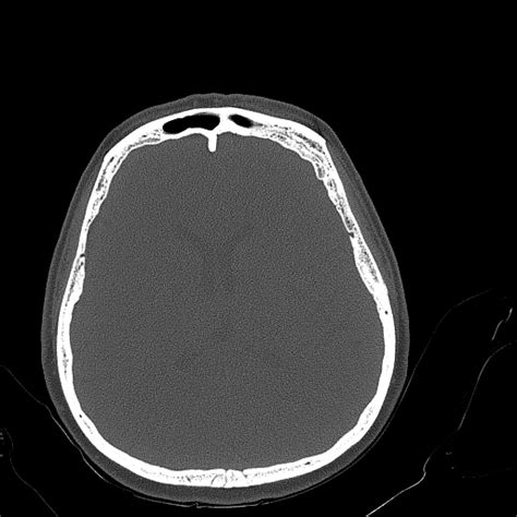 Лобный гиперостоз (hyperostosis frontalis interna)
