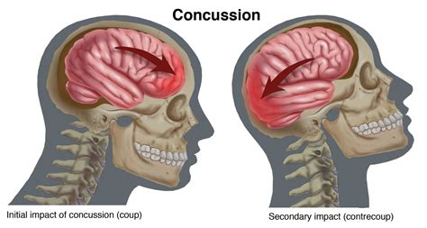 What Is A Concussion