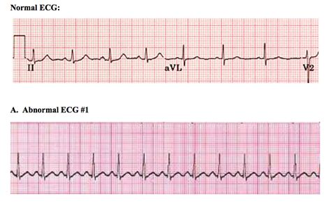 Image result for Normal vs Abnormal ECG