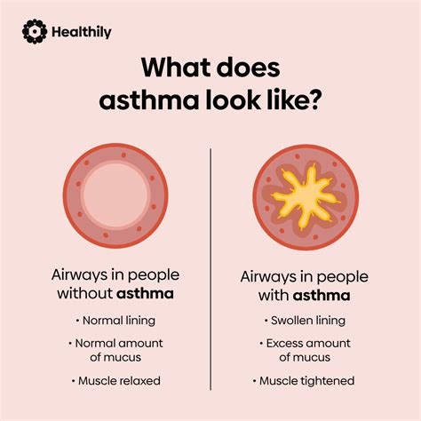 What Causes Asthma