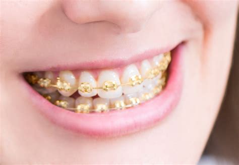Gold Braces Los Angeles et Beverly Hills | 360 orthodontie - Stupidly ...