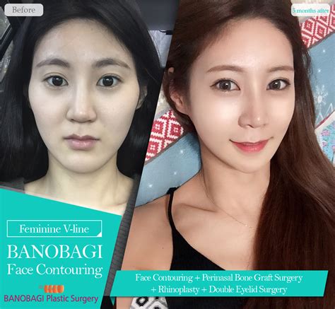 Pin on Face Contouring Surgery