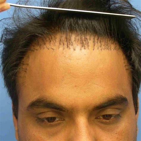 Best Hair Plugs Graft Selection In FUE Hair Transplant Using