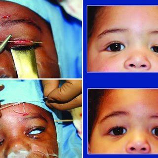 Image result for Levator Resection Surgery