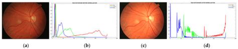 Retinal Blood-Vessel Extraction Using Weighted Kernel Fuzzy C-Means ...