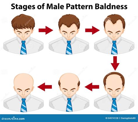 Balding Diagram