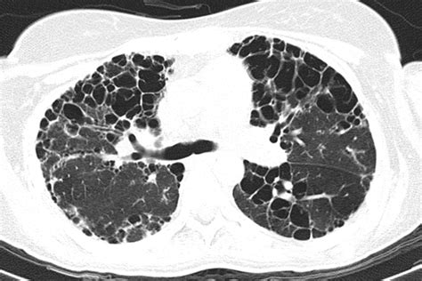 What Causes Rheumatoid Lung Disease at Taylah North blog