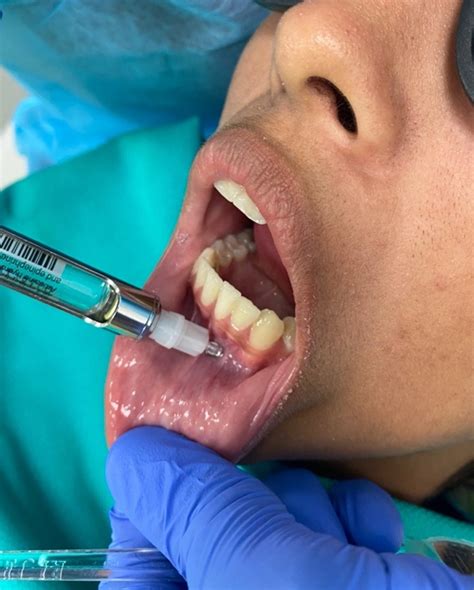 Infiltration Anesthesia Dental Lower 的图像结果
