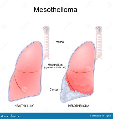 Mesothelioma. Lungs cancer stock vector. Illustration of mesothelioma - 283158326