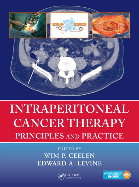 Image result for Intraperitoneal Therapy