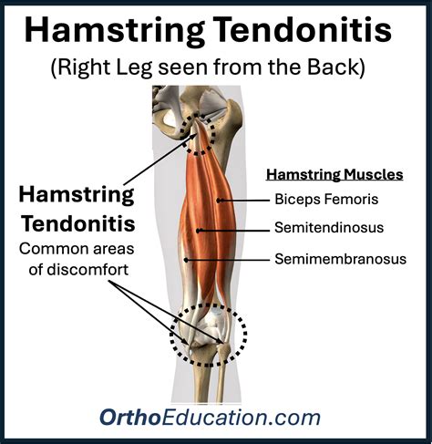 Hamstring Tendonitis - Knee Education