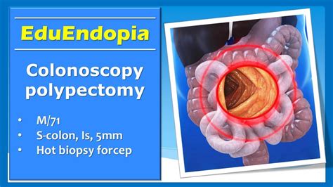 Image result for Colonoscopy Polypectomy