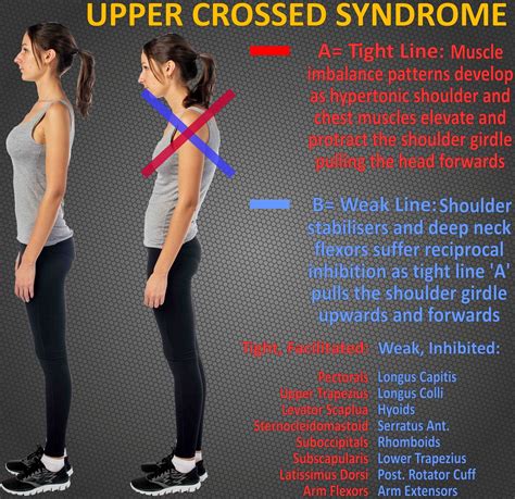 Upper Crossed Syndrome | Upper cross syndrome, Body anatomy, Muscle ...