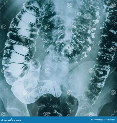 X-ray of the Human Intestine. Bowel Diseases Stock Photo - Image of ...