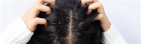 Get Rid of Dandruff This Winter with Ginger For Hair - Say Goodbye To ...