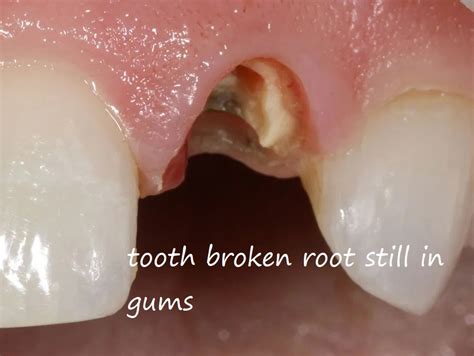 Image result for Root Extraction Tooth Broken Off