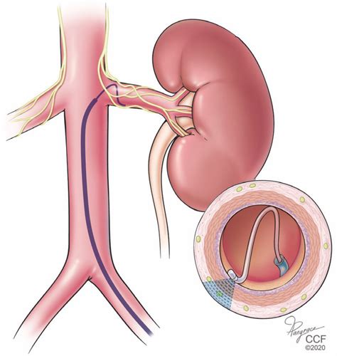 Stent In Kidney