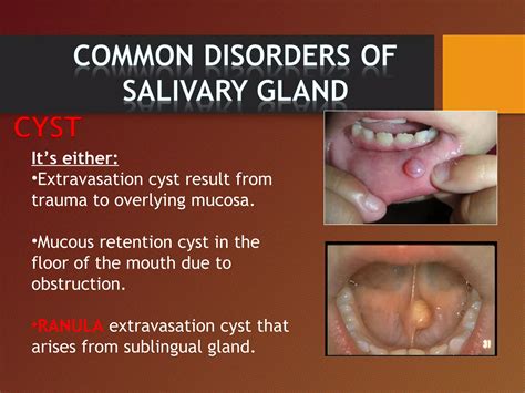 submandibular Salivary glands antomy | PPT