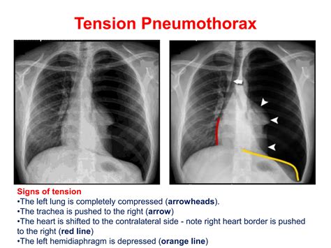 PNEUMOTHORAX IN CHEST XRAY INTERPRETATIONpptx | PPTX