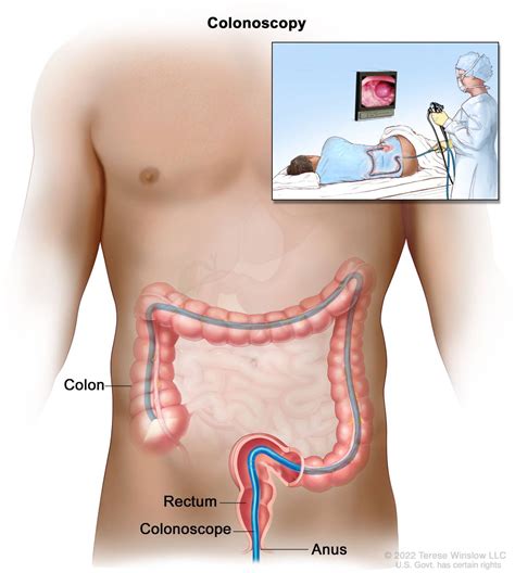Image result for Colonoscopy Process