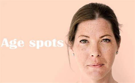 Remove Old Age Spots Naturally