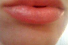 How to Treat a Swollen Lip Caused by Trauma | Healthfully