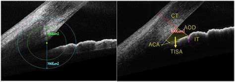 Anterior Chamber Configuration and Its Related Factors Among 8-Year-Old ...