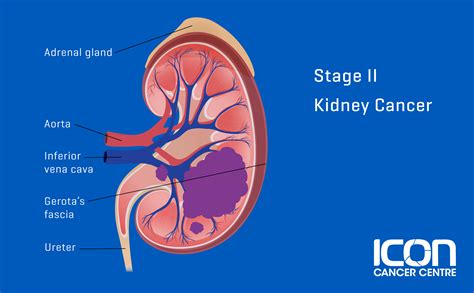 Stage 2 Kidney