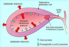 Continuing Antithrombic therapy safe during emergency lap chole for ...