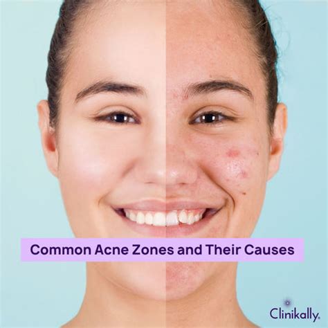 Acne Face Mapping: Decode Your Breakouts for Clearer Skin | Clinikally