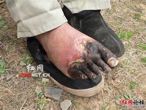 活人有没有生蛆的? - www.qiqiapk.com