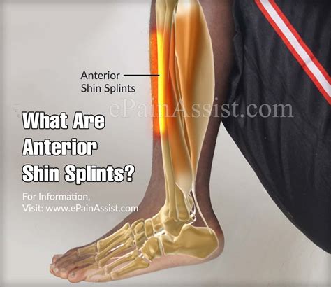 What Are Anterior Shin Splints?