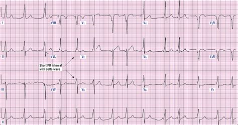 Heart Ablation Ventricular Tachycardia at Suzanne Hyatt blog