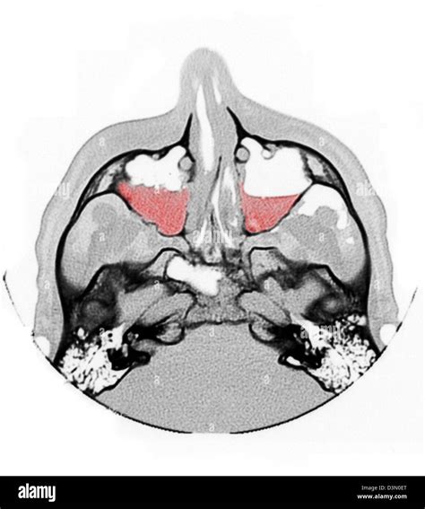 CT scan image showing bilateral maxillary sinus fractures Stock Photo ...