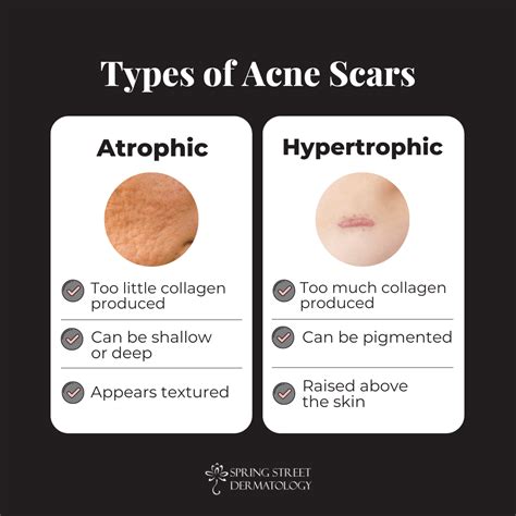 Acne Scar Types