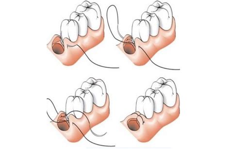How to Tie Figure 8 Sutures?