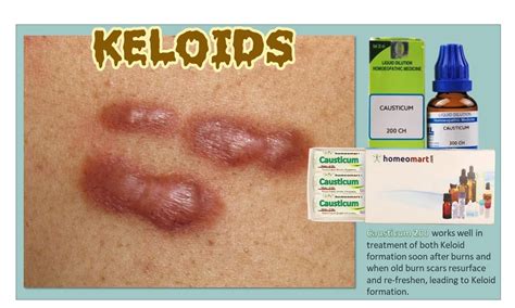 Best Homeopathic Remedies for Keloid Scars | Dr. Gopi's Expert ...