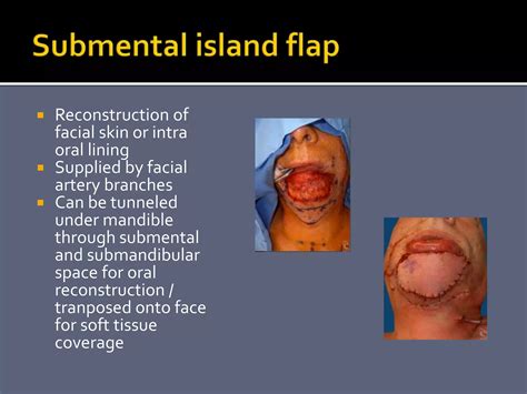 Local flaps in ent | PPTX