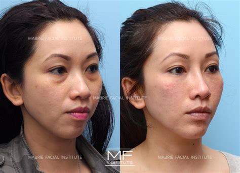 Nasolabial Fold Treatment With Filler & BOTOX® in the San Francisco Bay Area – Mabrie Facial ...