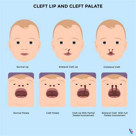 Cleft Lip Is Hereditary