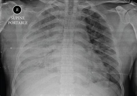 Hospital X-ray Chest 的图像结果
