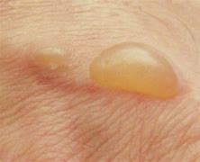 Image result for blisters