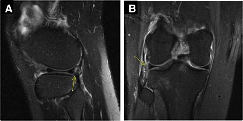 Arthroscopic Meniscus Repair Using an All-Inside, All-Suture, Knotless Device - Arthroscopy ...