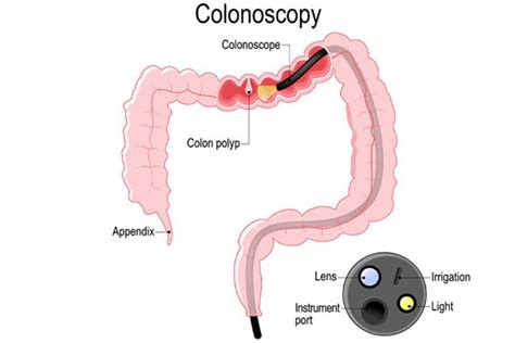 Image result for Loop Colonoscopy