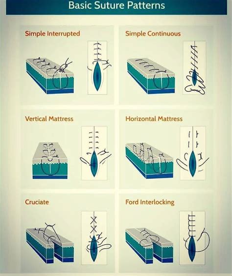 Image result for Continuous Suture Patterns